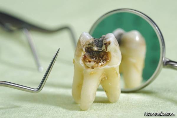 عصب کشی دندان 