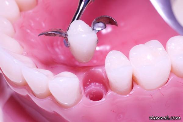 پروتز ثابت دندان