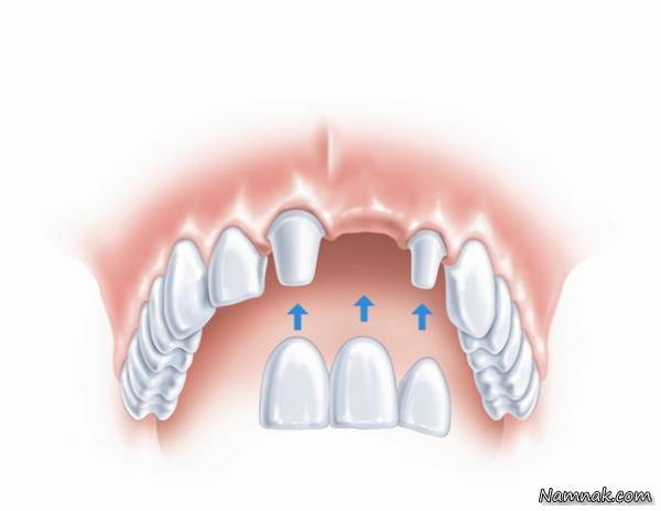 انواع پروتز ثابت دندان