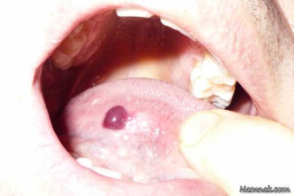 تاول های خونی دهان