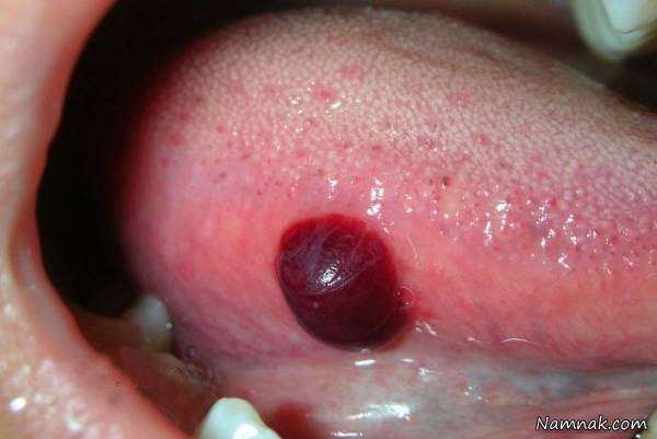 علت ایجاد تاول های خونی