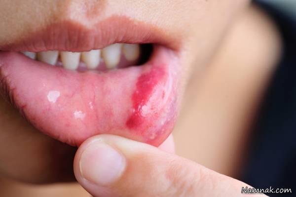 تاول های خونی در دهان
