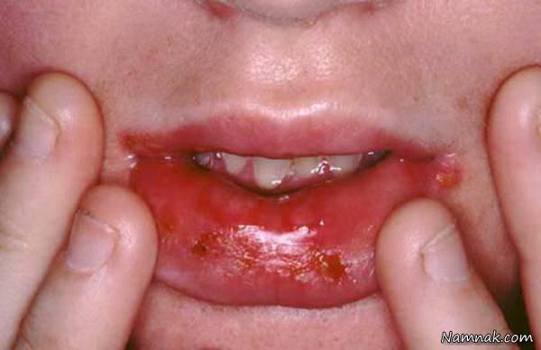 علت و درمان تاول های خونی دهان