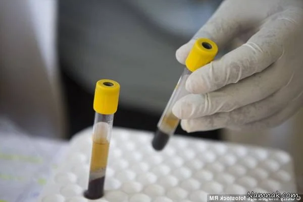  واکسن جدید ایدز HIV