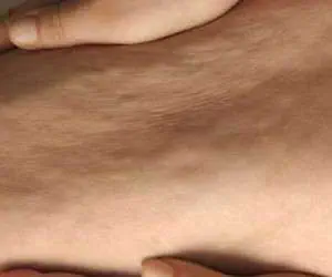 سلولیت