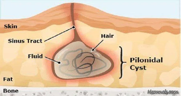 علت ابتلا به کیست مویی 