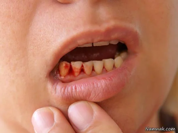 دلایل شایع خونریزی لثه 