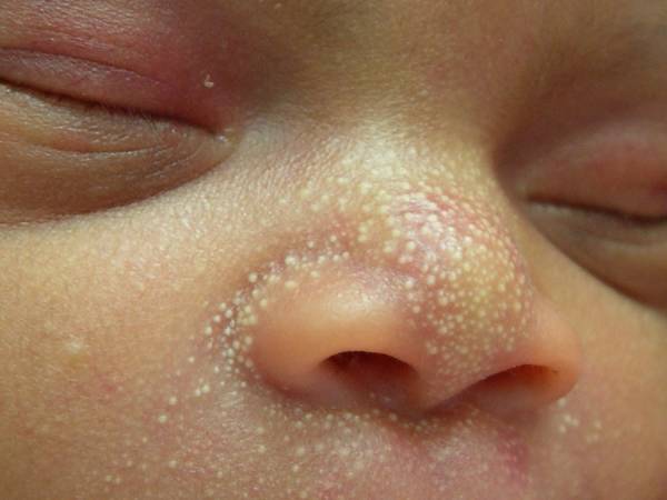 جوش های سفید زیر پوستی در نوزادان 