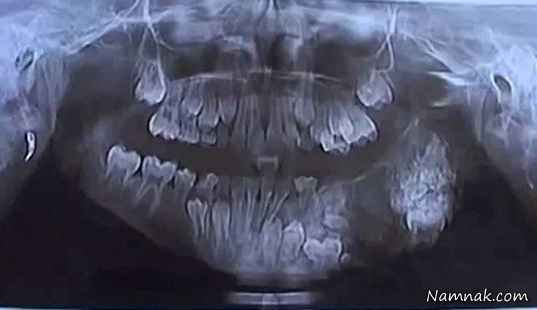 پسری با 80 دندان اضافه