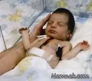 پیوند قلب