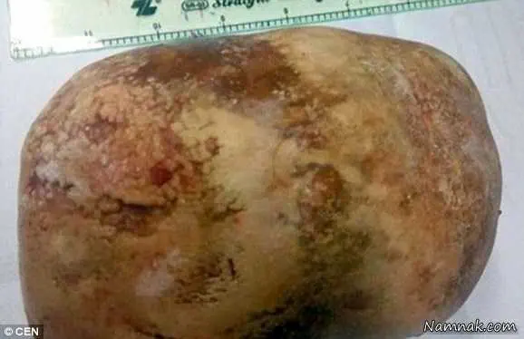 سنگ مثانه