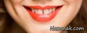 دندان های فاصله دار