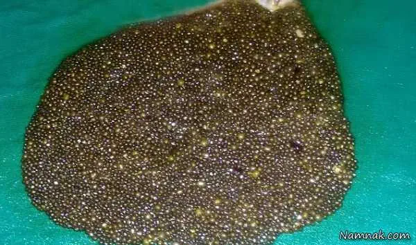 سنگ کیسه صفرا