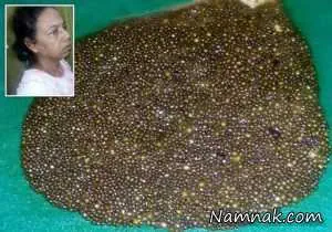 سنگ کیسه صفرا
