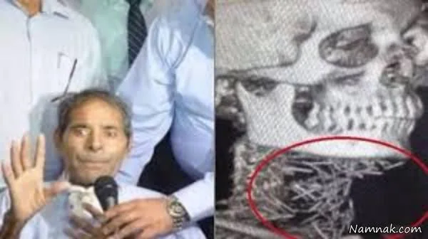 سوزن بدن 