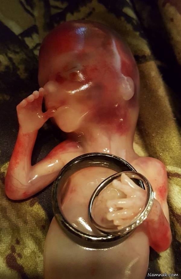 جنین سقط شده