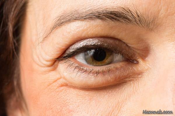 درمان کیسه زیر چشم
