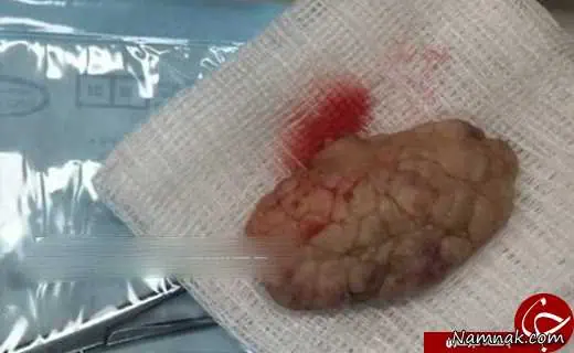 جراحی مغز