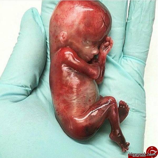 جنین سقط شده