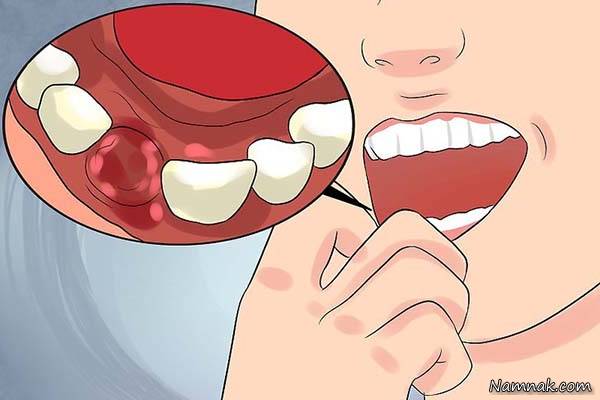 لخته شدن خون در دندان