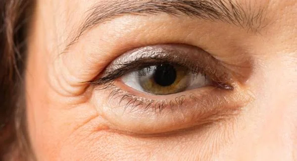 علت تیروئید چشمی