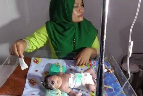 نوزاد یک چشم در اندونزی