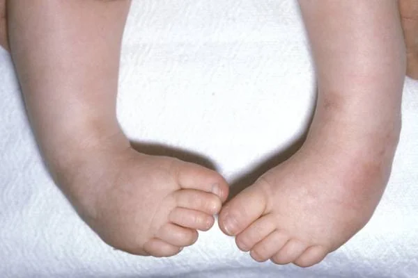عوارض پاچنبری