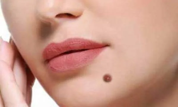 خال روی چانه