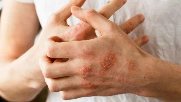 بیماری پسوریازیس