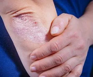 بیماری پسوریازیس