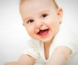 لب شکری کودکان