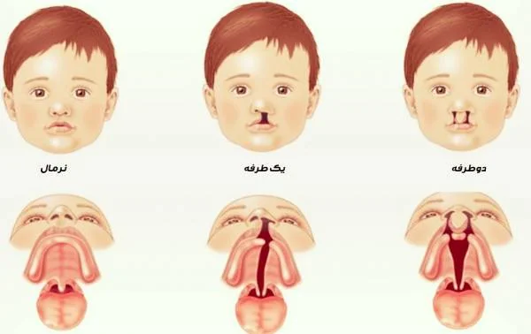 تشخیص لب شکری کودکان