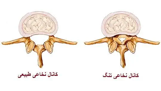 عوامل تنگی کانال نخاع