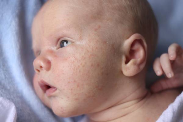 عرق سوز شدن گردن نوزاد درمانی فوری در خانه دارد