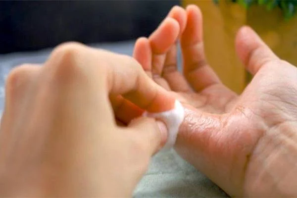 حلال چسب 123 روی پوست