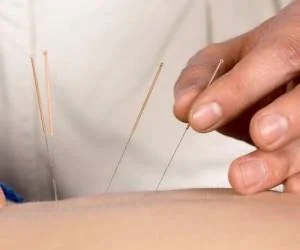  همه چیز طب سوزنی در بارداری ؛ از فواید و عوارض تا روش 
