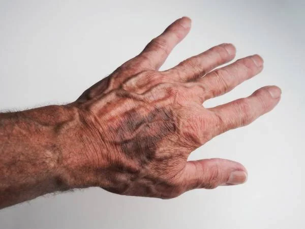 علل هماتوم