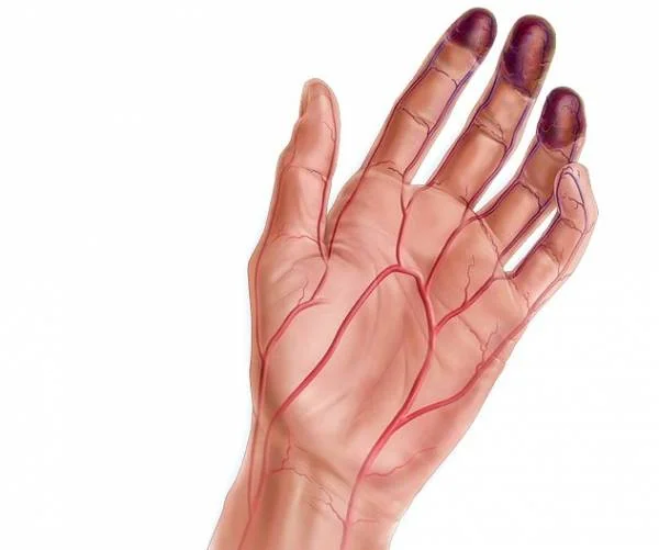 آنژیوگرام