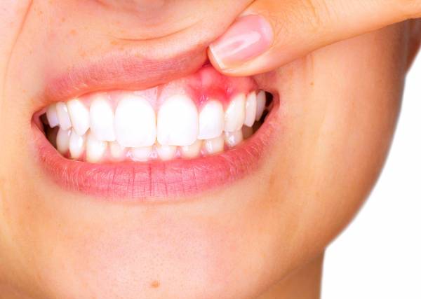 علائم آبسه دندان 