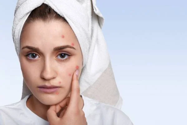 جوش زدن بعد از اصلاح