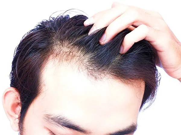 ریزش موی کاشته