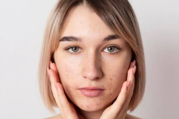 فواید سیر برای پوست کاهش اسکار پوست