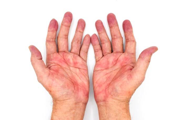 این نشانه‌ها بر روی پوست «کف دست» خبر از بیماری کبد می‌دهد