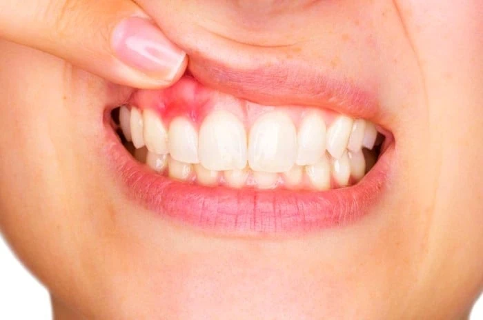 قرمزی و عفونت ایمپلنت